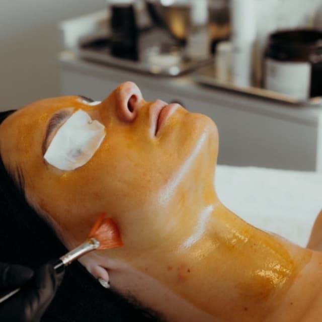 Light Peels at Yuliia Acne Expert in Hallandale Beach, FL